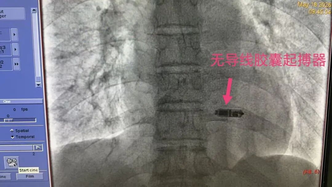 Leadless pacemaker case image from Xi'an Chang'an Hospital